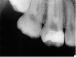 Figure 4. Laboratory-processed IPS Empress® onlay on tooth  No. 3 after bonding with Multilink® Automix.
