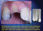 Figure 9. Endodontic treatment was performed on an emergency basis and temporized with composite until later in the day when time was available to complete the treatment.