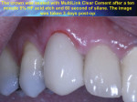 Figure 12. The crown was seated with MultiLink clear cement after a 10-minute 5% HF acid etch and 60 seconds of silane. The image was taken 3 days postoperative.
