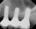 Figure 6  Splinted, cemented, implant-supportedrestorations at site Nos. 12 through 14 wasinserted 4.5 months after placement of implants.Radiograph shows restoration after 2 years infunction. (Restorations by Dr. Laura Torrado.)