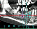 Figure 7  Pretreatment panoramic dental scanshows the lower right quadrant with simulated7-mm to 9-mm long implants at site Nos. 28 through30. There was 8 mm of residual bone height superiorto the IAN at site Nos. 29 and 30.