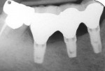 Figure 9  Periapical radiograph shows screwretainedimplant-supported prosthesis at siteNos. 28 through 30 inserted 4.5 months afterimplant placement.