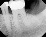 Figure 11  Periapical radiograph of site No. 18,taken 3 months after extraction, shows ridgeresorption and IAN proximity.