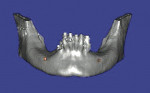 Figure 14  Three-dimensional view of severelyatrophic posterior mandible.