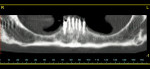 Figure 15  Pretreatment panoramic dental scanshows the ridge atrophy and nerve proximity.