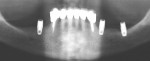Figure 19  Panoramic radiograph shows Locator® attachments (Zest Anchors Inc, Escondido, CA) onNeoss 3.5-mm x 7-mm implants at site Nos. 21 and 28 and on a 4.5-mm x 7-mm implant at site No. 19.