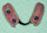 Figure 20  Mandibular RPD with Locatorattachments at site Nos. 19, 21, and 28 to stabilizeit and reduce stress on the remaining anteriorteeth.