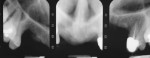 Figure 22  Pretreatment periapical radiograph shows a severely atrophicanterior maxilla and remaining posterior dentition. The patient presented 15years after a motor vehicle accident that avulsed her anterior teeth andfractured her premaxilla.