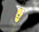 Figure 23  With simulated placement of a 3.3mm x 8 mm implant at site #8 showing limitedbone width and proximity to nasal floor. Pleaseunderstand these are photos from an older dentalscan and the quality is never that of newerdigital radiographs.