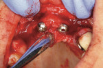 Figure 24  Implant insertion at site Nos. 8 and 9.