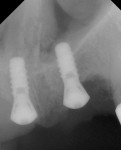 Figure 5  Periapical radiograph shows 3.3-mmx 8-mm Regular Neck Straumann implantsplaced with a minor nasal floor lift.