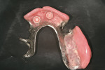 Figure 27  Maxillary removable prosthesis.