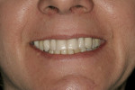 Figure 28  Smile view of the inserted prosthesis.(Prosthesis by Dr. Bruce Valauri.)