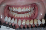 Pre-treatment photograph before in-office whitening. Note the lack of hygiene
compliance.