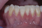 Pre-surgery: gingival recession and lack of attached gingiva.