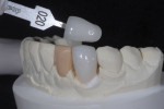 The porcelain lateral incisor was duplicated in wax followed by fabrication of IPS e.max canine crown.