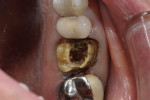 Case 1 preparation down to the level of the gutta-percha from previous endodontic therapy.