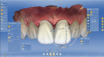 Digital creation of multiple anterior restorations.