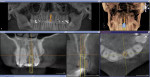 CEREC was used to plan implant placement in a difficult case with bone loss and an enlarged incisive canal.