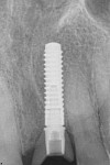 Radiograph showing precise placement of the implant as planned with the CEREC software.