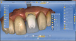The restorative component of the CEREC implant planning workflow.