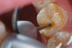 Figure 3  An inverted cone bur was used toremove a thin layer of residual RMGI material.