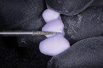 The needle medium-grit diamond bur is ideal for fine margin adjustments as well as adjustments to the connector that help provide depth and detail prior to characterization.
