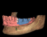 Fig 3. Partially edentulous patient case; patient CBCT scan data (brown) with overlay of patient model optical scan (red) and optical scan of wax-up of the planned restoration (blue), before treatment planning.