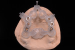 Fig 8. Fully edentulous surgical guide produced using additive 3-D printing (image courtesy of Dickerman Dental Prosthetics, dickermandental.com).