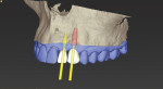 Fig 5. Some types of software allow for planning using “virtual teeth,” limiting the need for laboratory-fabricated diagnostic wax-ups (image courtesy of Dental Wings, dentalwings.com).