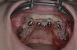 Fig 5. Maxillary implants placed through the surgical guide.