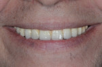 Fig 17. Patient’s smile with completed restoration.