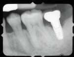 Fig 1. Analog radiograph of implant site affected by peri-implantitis.