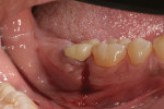 Fig 3. Periodontal abscess with bleeding and suppuration.