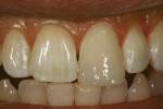 Figure 9  The translucency of the enamel mimickingcomposite brought vitality to the restoration.Note that although shade matching appearedinadequate on the day of completion, this illusionis caused by desiccation of the adjacent naturaltooth during b