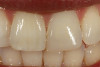 Fig 7 Combination RPD cases with attachments on abutments are an important part of esthetic or cosmetic removable partial dentures. A lingual plate was used due to minimal lingual depth, plus the plate provides a guide for placement on attachments. With this maxillary RPD combination case, minimal metal with maximum support was important. The palatal gingival margins of the crowns was opened 4-6 mm, plus the crowns had a milled surface with a contoured lingual ledge strap.