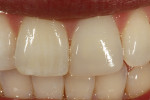Figure 10  At the 1-week follow-up, the surfacegloss was achieved using standard polishingprotocols. Note that the true shade matchwas evident after the adjacent tooth rehydrated.