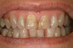 Figure 11  Preoperative, highly chromatic maxillaryanterior incisors.
