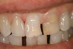 Figure 12  The prepared right central incisor.