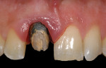 Fig 2. Once the existing crown
was removed, the excessive apical placement of the preparation’s margin was apparent.