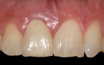 Fig 5. The clinical appearance of the definitive crown after 1 year in situ showed that the soft-tissue profile was stable and symmetric with the left central
incisor (natural tooth).