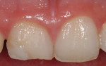 Fig 6. Right central incisor had a deficient composite restoration and palatal caries requiring a full crown restoration.