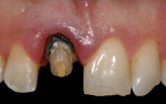 Fig 3. Proper
axial-gingival reduction was completed, and initial gingival margin was placed coronal to the CEJ of
adjacent central incisor.