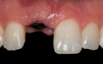 Fig 14. The gingival frame before placement of the definitive implant-supported ceramic restoration
demonstrated deficient papillae height.
