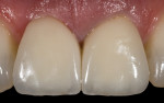 Fig. 19. The definitive porcelain crowns with optimal gingival profile complete
the illusion of natural teeth.