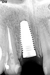 Figure 4  A radiograph confirmed that the top of the implant platform was placed 3 mm apical to the free gingival margin of the extraction site and allowed measurement of the distance between the facial aspect of the implant and the buccal plate, whi