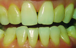 Fig 1. The patient's composite veneers had become discolored and tissue had migrated.