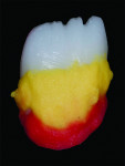 Fig 5. Darker A2 dentin was applied on the gingival aspect and bright opacious Dentin BL2 mixed with 10% Mamelon orange-yellow was applied on heights of contour to 
raise the value which would be offset by subsequent layers and firings.