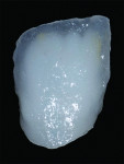 Fig 9. The canvas-like foundation would allow the restoration to harmonize with surrounding dentition.