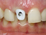 Figure 12  The zirconia abutment in place for try-in.